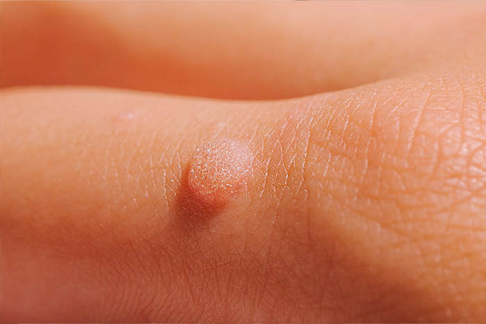 hpv