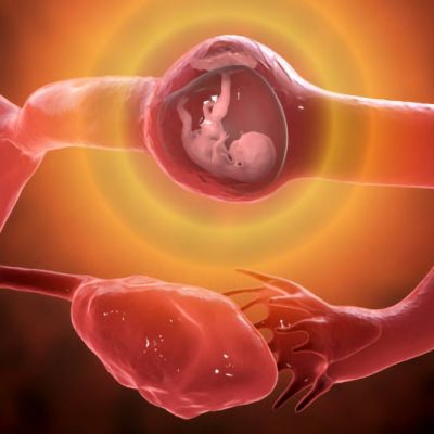 Tubal ectopic pregnancy, 3D illustration showing an 8-week human fetus implanted in the fallopian tube instead of uterus