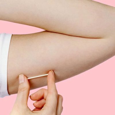 implante-hormonal-implanon